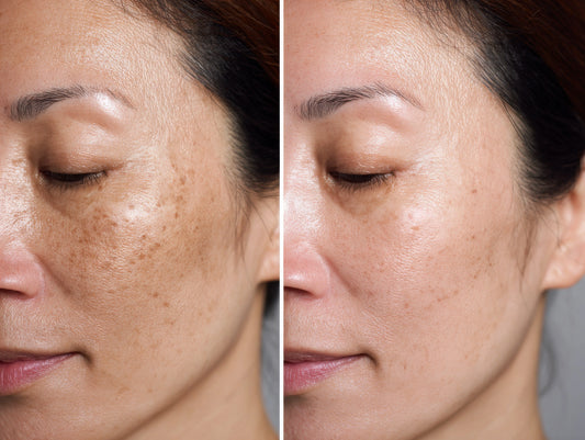 Do You Have Hyperpigmentation? Understanding Hyperpigmentation: Causes, Types & Effective Treatments 2026